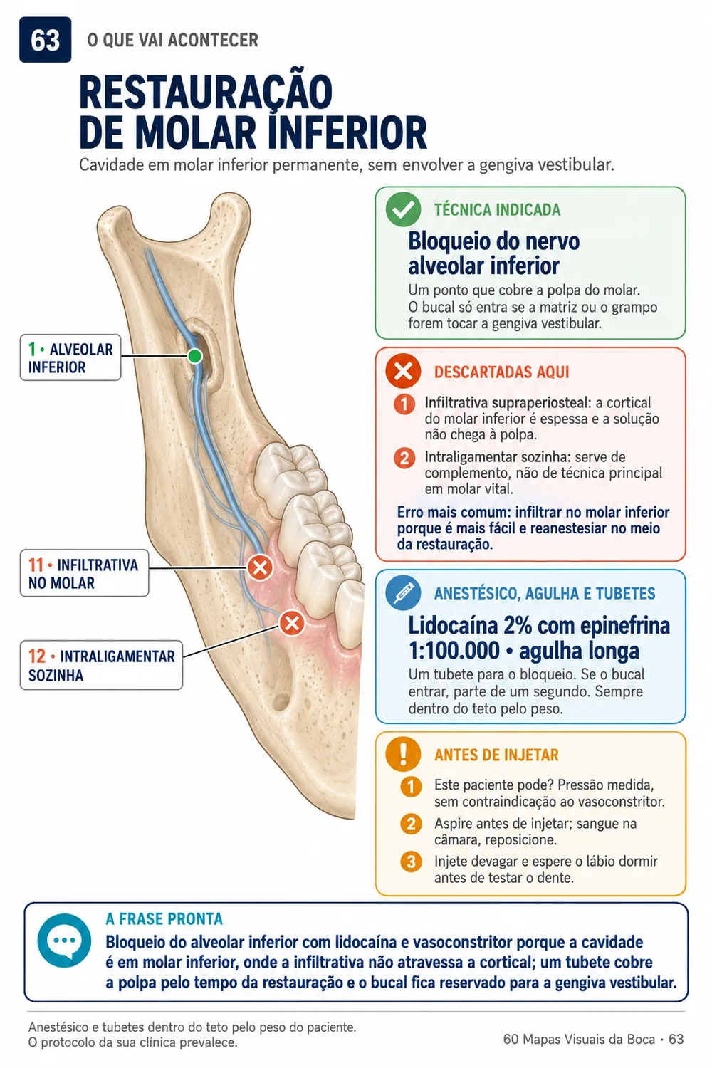 Cruzamento: restauração de molar inferior