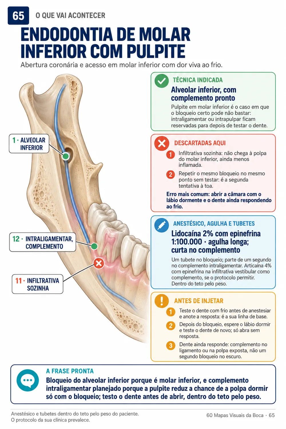 Cruzamento: endodontia de molar com pulpite